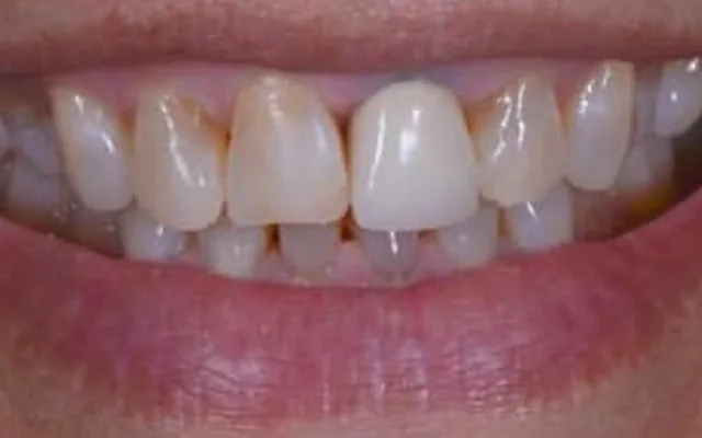 Antes: dientes anteriores con manchas, desgaste y tamaños distintos