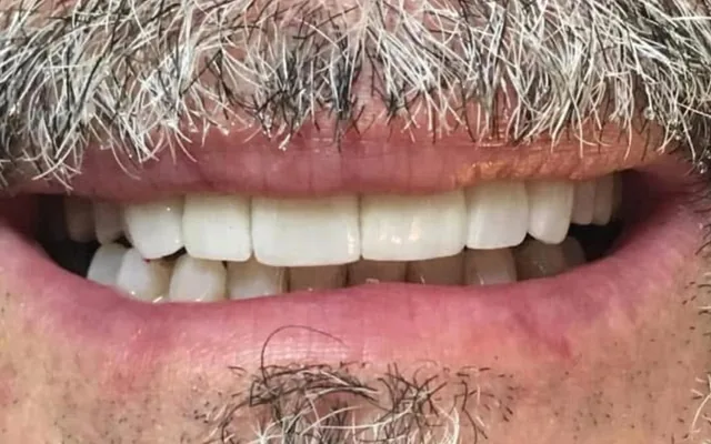 Después: dientes superiores blancos, parejos y sin espacios